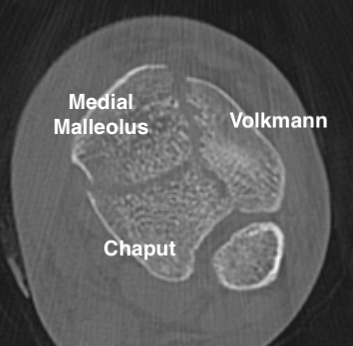 Tibial plafond fragments